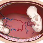 Hội chứng song thai không tim, dị tật hiếm gặp và vô cùng nguy hiểm