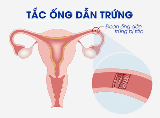 Tắc ống dẫn trứng - Thủ phạm hàng đầu gây vô sinh ở nữ giới