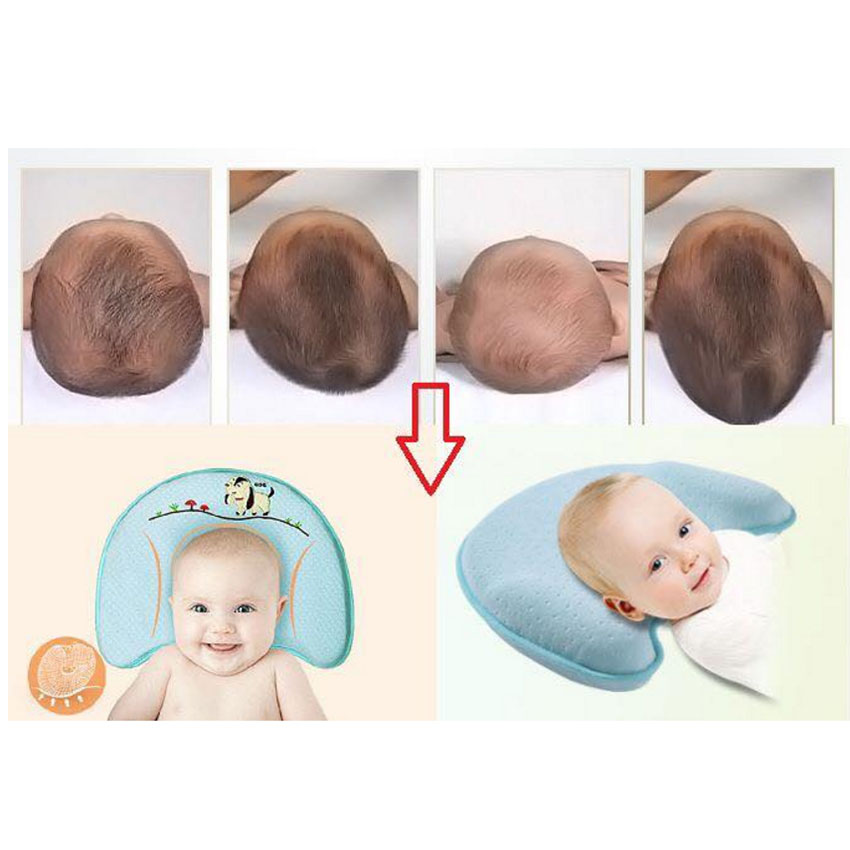 Bẹp đầu ở trẻ sơ sinh và cách xử lý