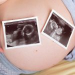 Sinh đa thai là gì? Những điều mà mẹ cần biết về sinh đa thai?