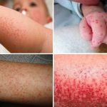 Cảnh giác với biến chứng sốt xuất huyết nguy hiểm ở trẻ