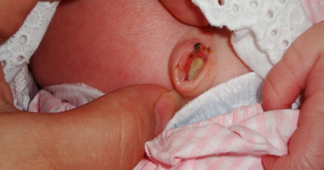 Nhiễm trùng rốn ở trẻ sơ sinh: Dấu hiệu, nguyên nhân và cách điều trị