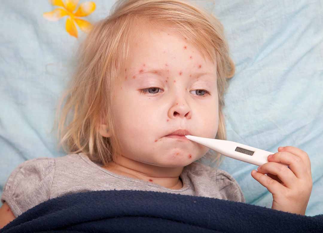 Triệu chứng và hướng điều trị bệnh sốt xuất huyết ở trẻ