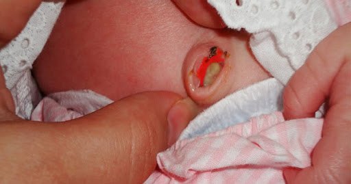Rốn trẻ sơ sinh bị chảy máu có nguy hiểm không và cách khắc phục?