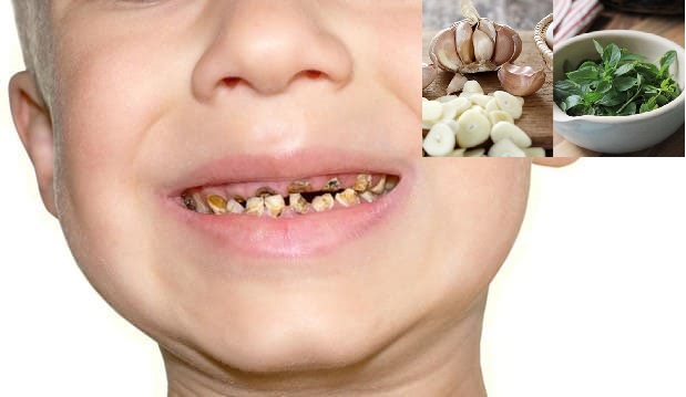 Ba cách trị sún răng an toàn cho trẻ mà không cần dùng thuốc Tây