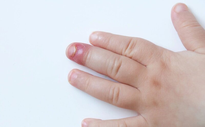 Nấm móng tay ở trẻ: Nguyên nhân và cách điều trị hiệu quả