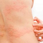 Nổi mề đay sau sinh: Nguyên nhân, dấu hiệu và cách điều trị an toàn
