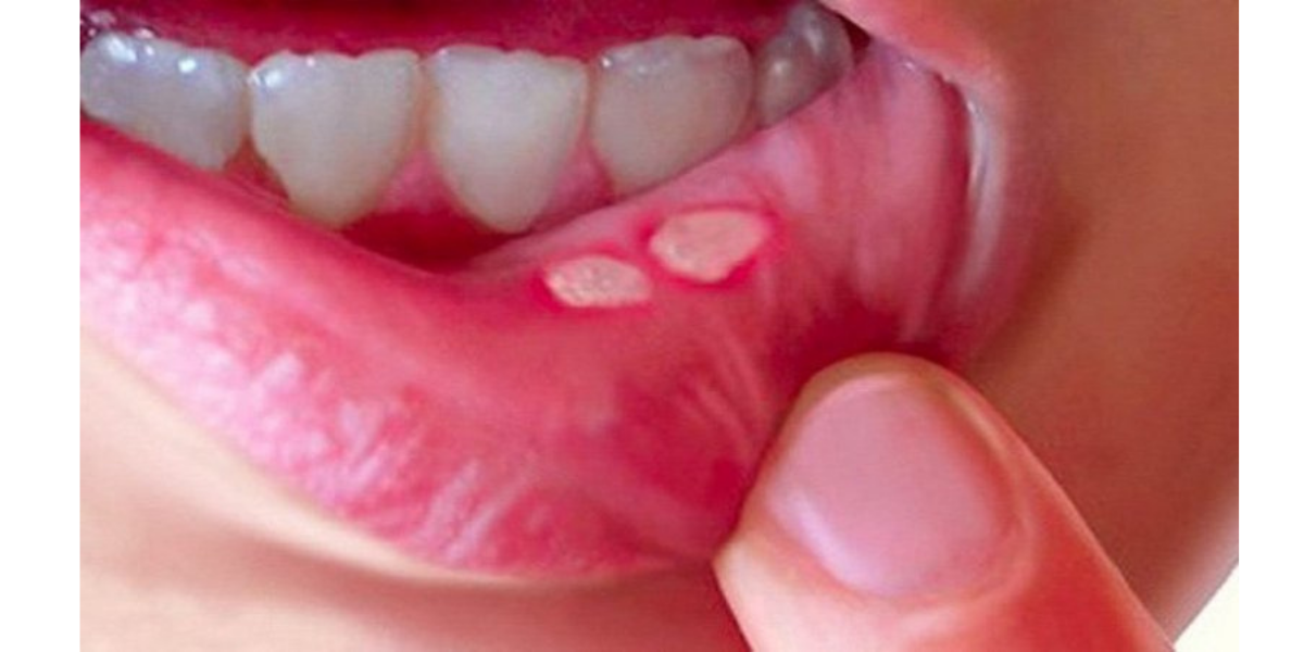 Cách chữa lở miệng cho bé tại nhà bằng cách nguyên liệu tự nhiên không cần thuốc