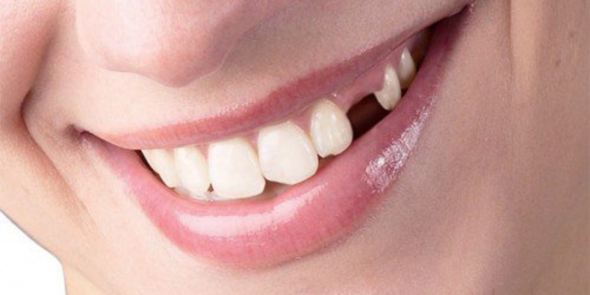 Những điều cần biết về tiêu xương răng để giữ gìn nụ cười tươi tắn