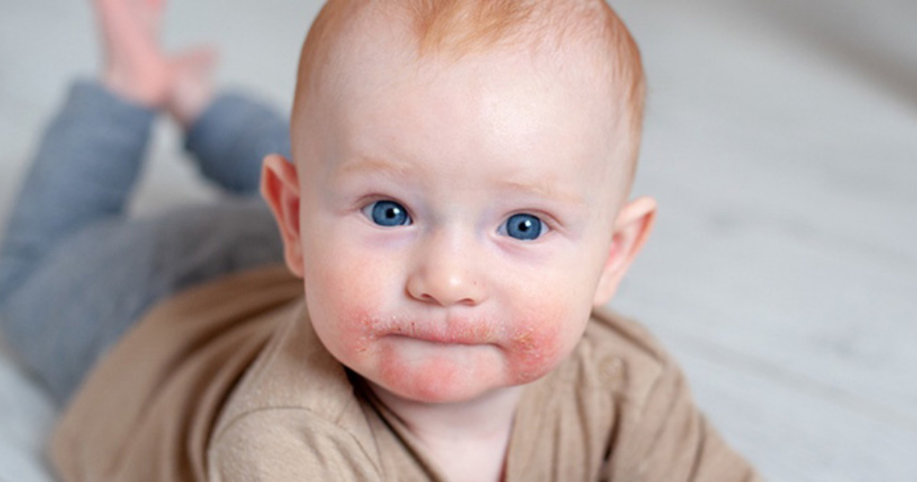 Trẻ bị chàm sữa: Dấu hiệu, nguyên nhân và cách điều trị