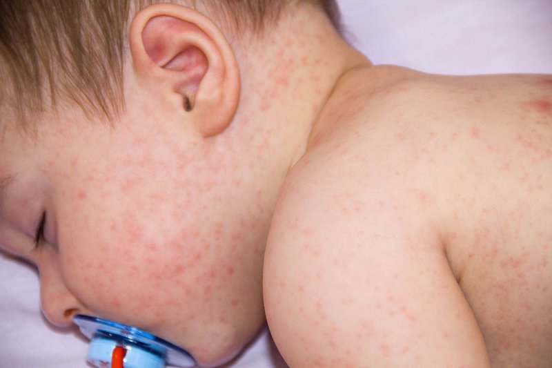 Mách cha mẹ những cách xử lý khi trẻ bị sốt phát ban