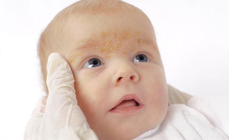 Trẻ sơ sinh bị khô da: Cha mẹ cần làm gì để da con được mềm mướt?