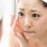 Bị mụn tuyệt đối nên tránh những loại thực phẩm này