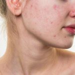 Những sai lầm phổ biến nào khi sử dụng retinol khiến làn da bị kích ứng ?