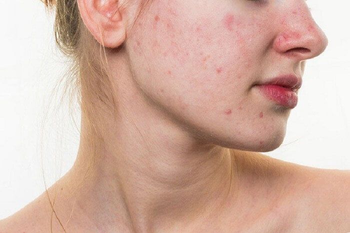 Những sai lầm phổ biến nào khi sử dụng retinol khiến làn da bị kích ứng ?