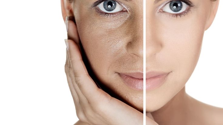 Sự thật về điều trị nám da: Hiểu đúng để không mất tiền oan