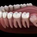 Không mọc răng khôn – Thiếu sót hay tiến hóa tự nhiên của con người?
