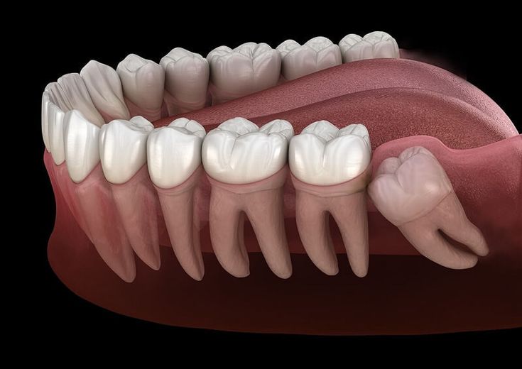Không mọc răng khôn – Thiếu sót hay tiến hóa tự nhiên của con người?