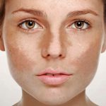 Nước cốt chanh có làm mờ tàn nhang? Hiệu quả đến đâu và cần lưu ý gì?