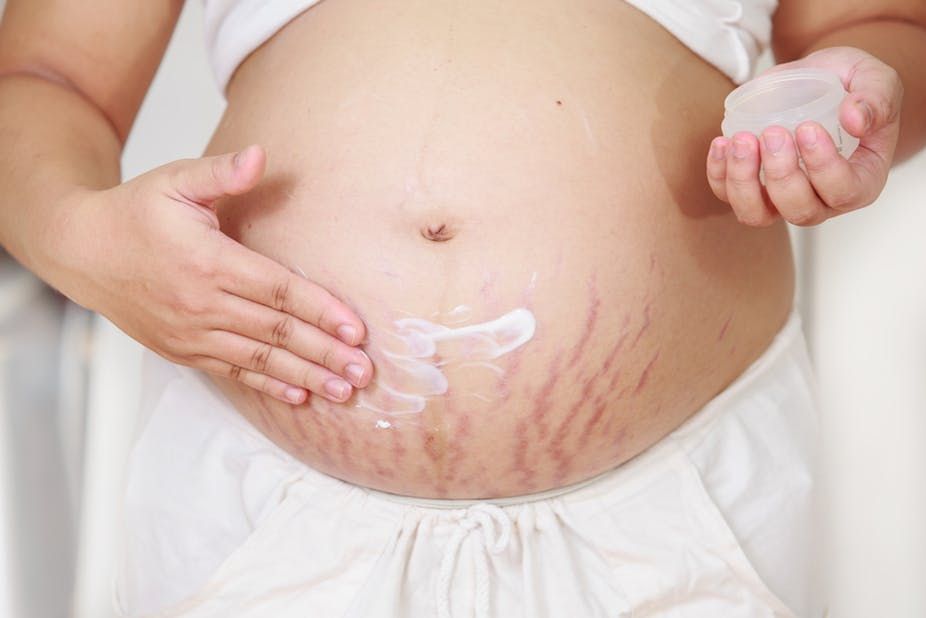 Nguyên nhân gây rạn da khi mang thai: Mẹ bầu cần biết để phòng ngừa sớm