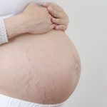 5 kiểu cơ địa mẹ bầu dễ bị rạn da nhất – Kiểu số 2 rất phổ biến