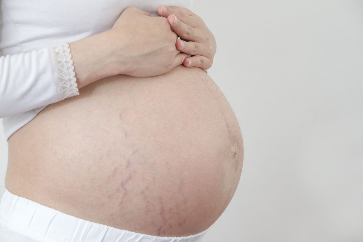 5 kiểu cơ địa mẹ bầu dễ bị rạn da nhất – Kiểu số 2 rất phổ biến