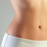 Trị rạn sau sinh bằng công nghệ cao: Nên bắt đầu từ khi nào để đạt hiệu quả tốt nhất?