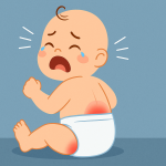 Bé bị hăm tã phải làm sao? Cách chọn bỉm ngừa hăm hiệu quả