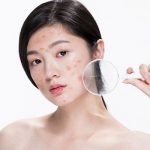 Từ trị mụn đến phục hồi: Hành trình lấy lại làn da khỏe mạnh