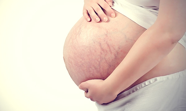 Rạn da có di truyền không? Bác sĩ lý giải nguy cơ từ gia đình