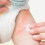 Bé bị dị ứng bỉm: Nguyên nhân và cách khắc phục hiệu quả