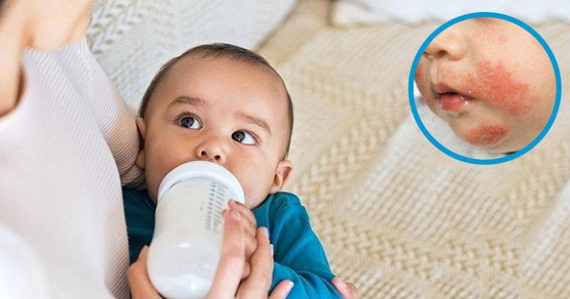Cảnh giác dị ứng sữa ở trẻ nhỏ: Dấu hiệu nhận biết và cách xử trí