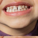 Vì sao răng trẻ xuất hiện mảng bám đen dù vệ sinh đầy đủ?