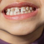 Vì sao răng trẻ xuất hiện mảng bám đen dù vệ sinh đầy đủ?