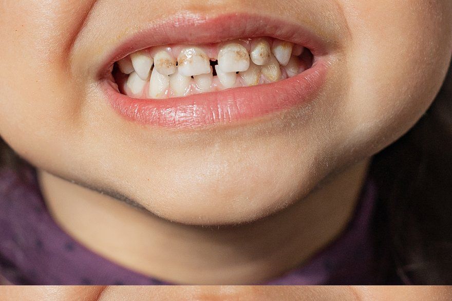 Vì sao răng trẻ xuất hiện mảng bám đen dù vệ sinh đầy đủ?