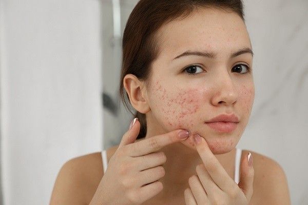 Những sai lầm phổ biến khiến mụn không dứt dù skincare đầy đủ