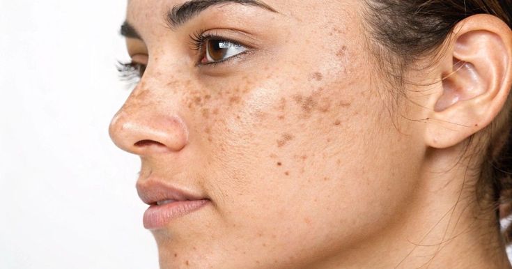 4 lý do khiến lỗ chân lông giãn to và cách chăm sóc da chuẩn khoa học